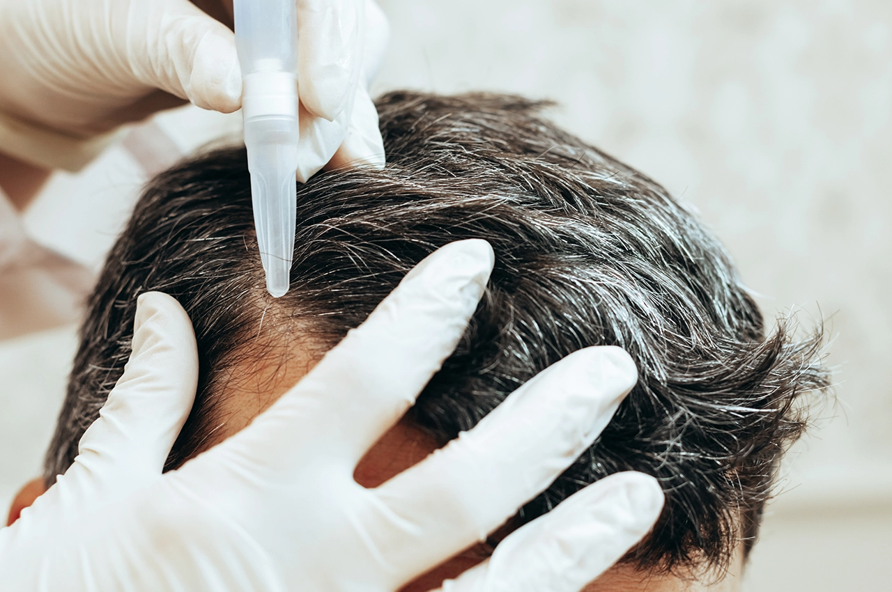 حقن الميزوثيرابي في فروة رأس رجل لعلاج تساقط الشعر في الشارقة