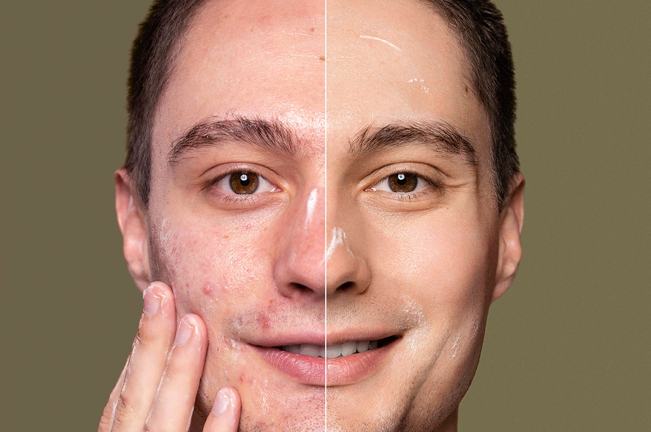 رجل يُظهر نتائج علاج حب الشباب قبل وبعد، مع بشرة أكثر صفاءً في مركز متخصص في علاج حب الشباب في الشارقة